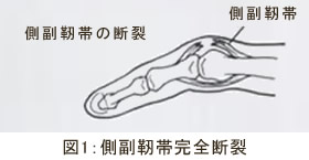 側副靭帯完全断裂